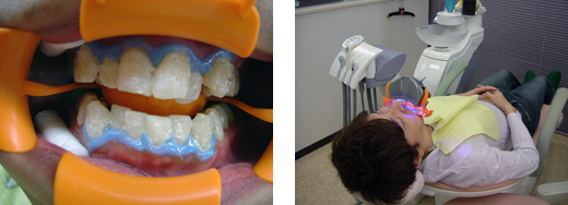 whitening