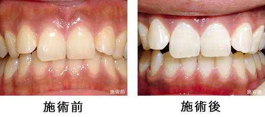 whitening_ba